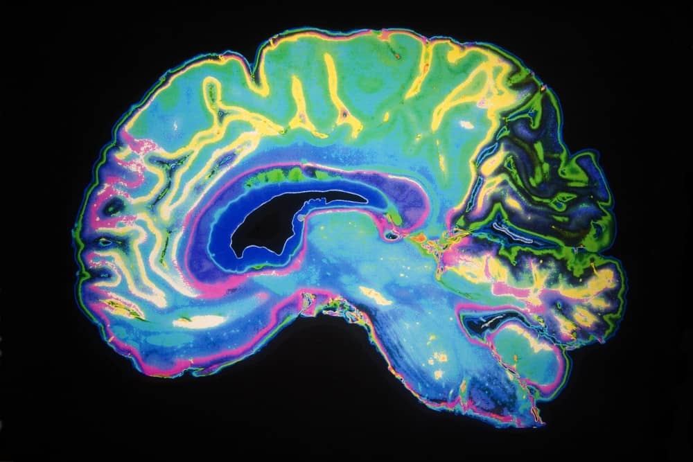 Cura Alzheimer, ricerca lo ferma mirando a una piccola proteina.